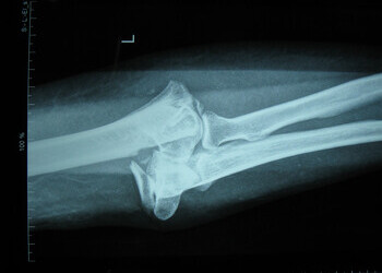 Closed left supracondylar fracture of the humerus with intercondylar split 2012-07-14
