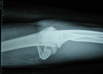 Closed left supracondylar fracture of the humerus with intercondylar split 2012-07-14