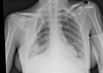 Right flail chest with lung contusion and closed right scapula fracture 2012-07-14