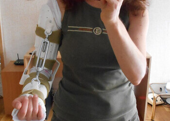 Custom made splint by Johanna Jacobson-Petrov to help with the contracture 2013-06-27