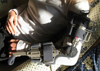 Orthosis - a brace, splint to help with the contracture 2013-11-12